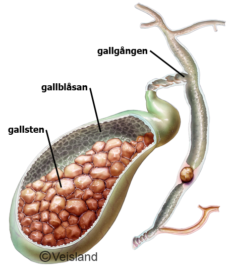 gallsten